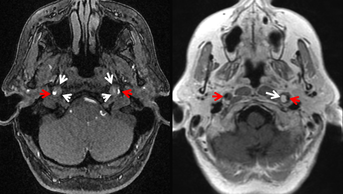 pulsatile-tinnitus-carotid-artery-dissection-neuroangio